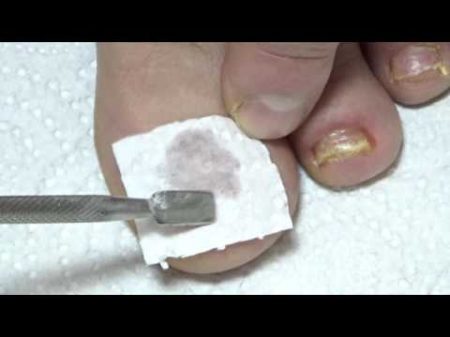 Лечение от грибка ногтей НАРОДНЫЙ МЕТОД
