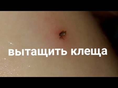 Как мы вытащили клеща ниткой how to remove a tick cómo tirar de un ácaro