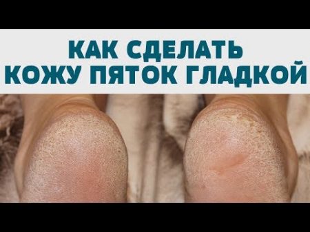 ПЯТОЧКИ КАК У МЛАДЕНЦА! Как избавить стопы ПЯТКИ от НАТОПТЫШЕЙ ТРЕЩИН ГРУБОЙ КОЖИ