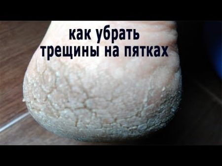 Пятки как у младенца Простой рецепт убрать трещины на пятках