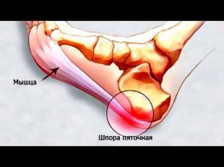 Пяточная шпора Как я быстро ее вылечила Простой метод