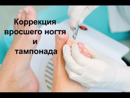 Коррекция вросшего ногтя и тампонада Correction of ingrown nail and tamponada