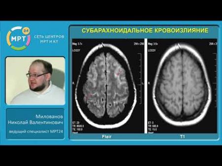 МРТ в диагностике острых нарушений мозгового кровообращения по ишемическому типу