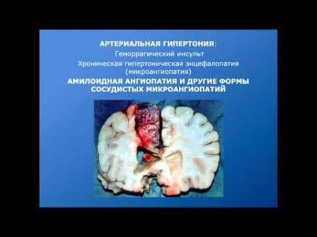 Неврология Сосудистая патология мозга в нейрохирургической клинике