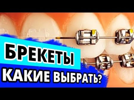 Какие выбрать брекеты Совет ортодонта из Москвы