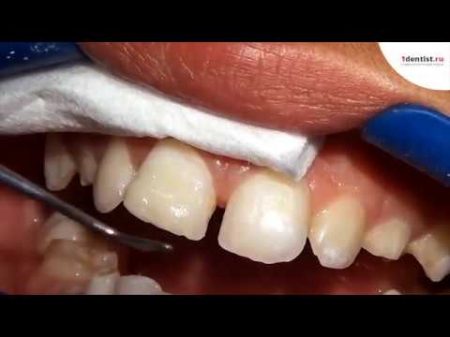 Восстановление переднего зуба после скола