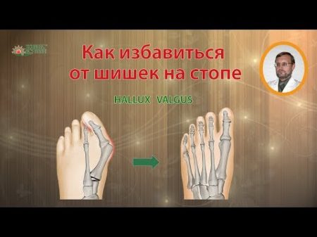 Как избавиться от косточки или шишки на большом пальце стопы Hallux Valgus