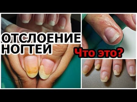 ОНИХОЛИЗИС Отслоение ногтей Причины Диагностика Устранение