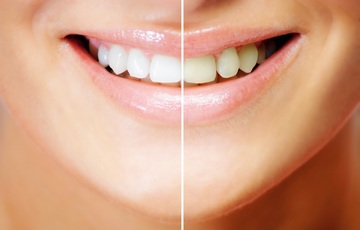 Белоснежная улыбка: отбеливаем зубы по новой технологии